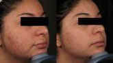 PEELING DE DIAMANTE