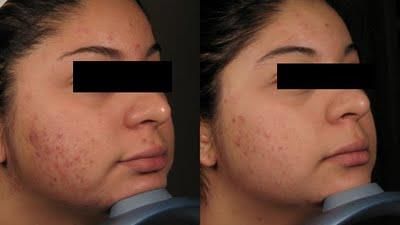 PEELING DE DIAMANTE